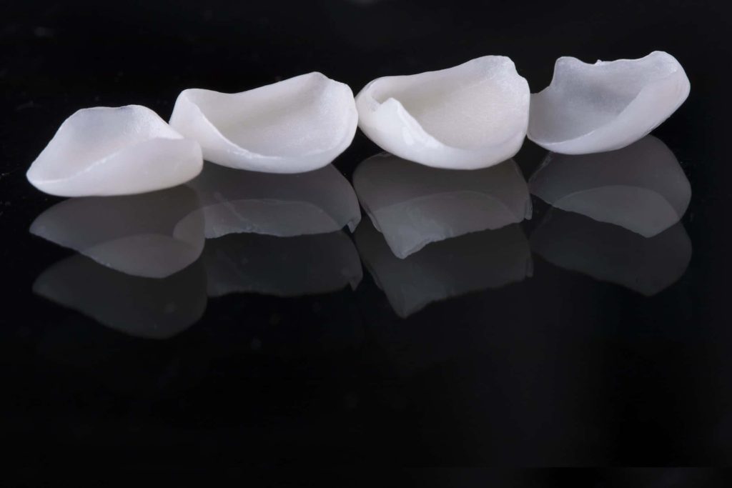 Types de facettes dentaires : Facette dentaire en céramique, facette dentaire en porcelaine et facette en zircone à Bejaïa en Algérie Hollywood smile avec Facettes dentaires à Bejaïa en Algérie