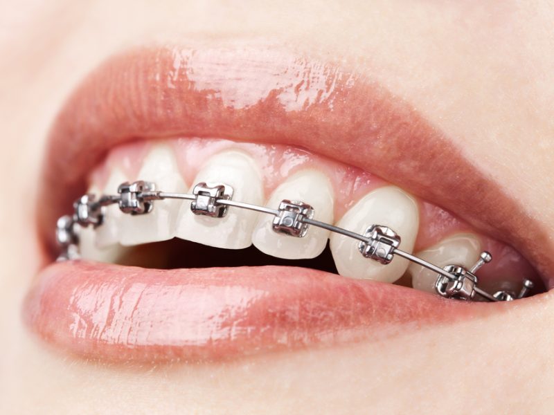 appareil-dentaire-metalique