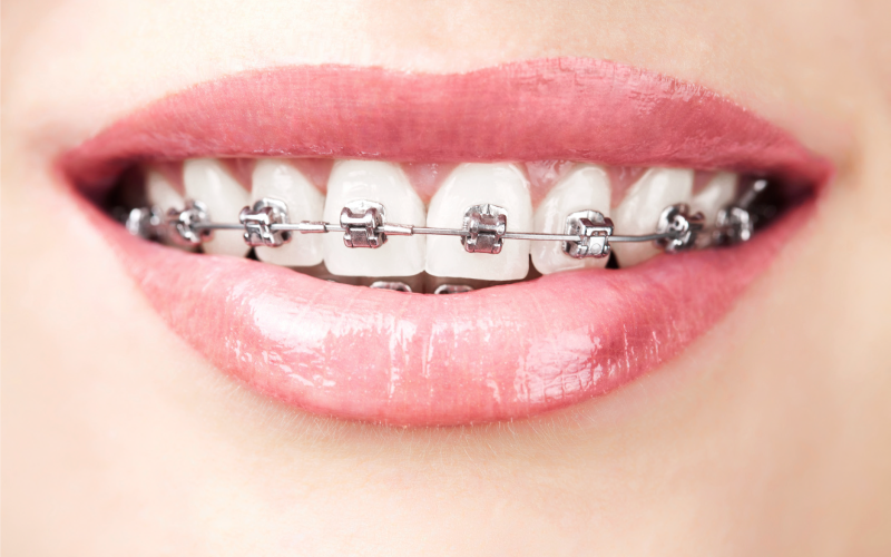 Hollywood Smile : orthodontie ou facettes dentaires ?