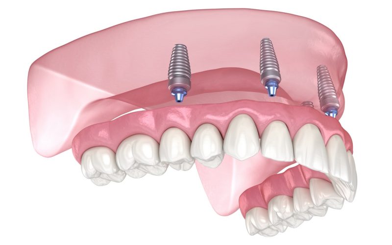 Types de prothèses dentaires - Ma santé bucco-dentaire